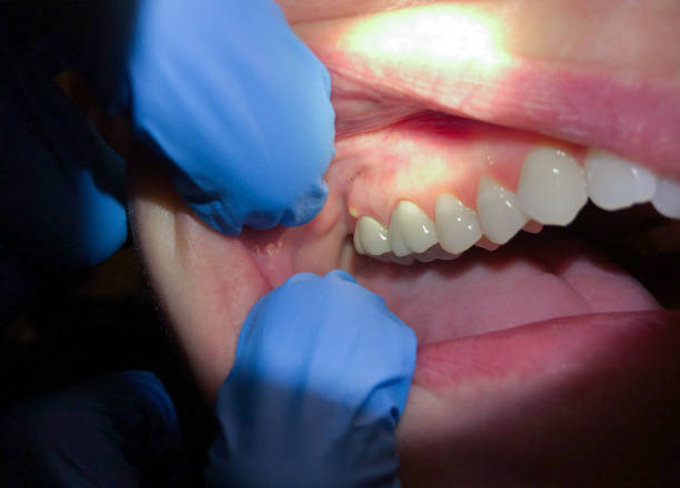 Best Urgent Care for Lost Fillings or Crowns in Bells, TX