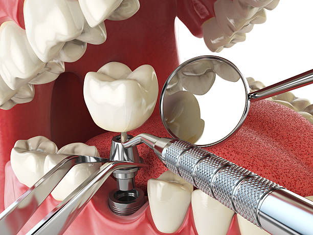 Best Emergency Root Canal Treatment in Bells, TX